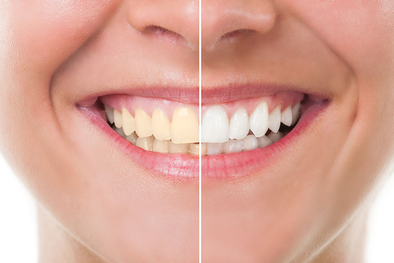 Teeth Whitening in Vancouver
